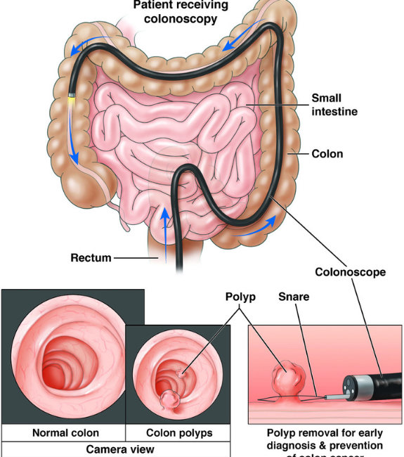 Colon Polyp Removal_1