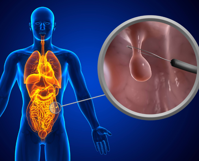 Polyp Removal Expertise
