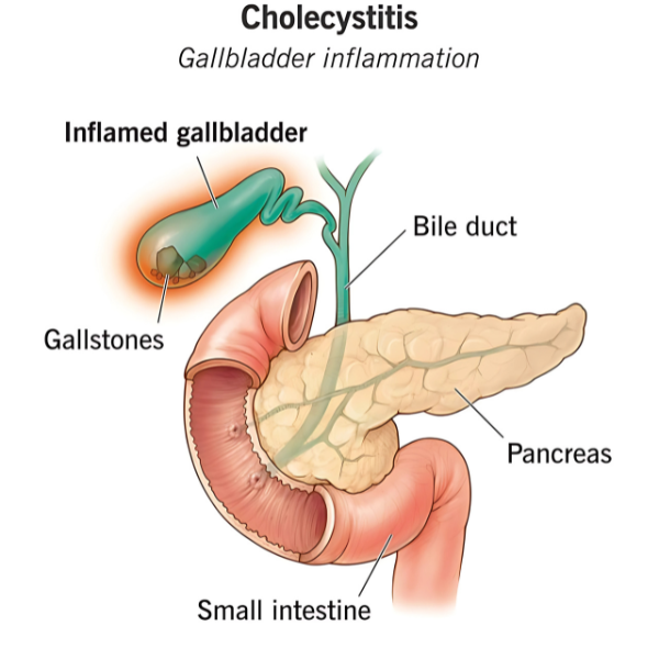 Gall Bladder Diseases
