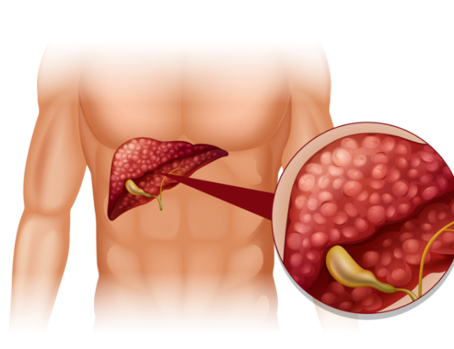 Biliary Stenting