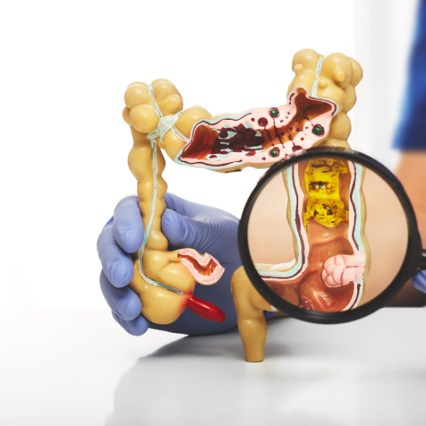Colon Polyps Removal