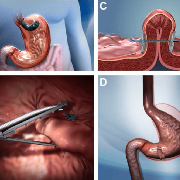 Endoscopic Obesity