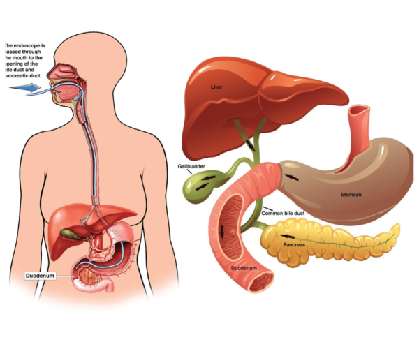 _(Endoscopic Retrograde Cholangiopancreatography)