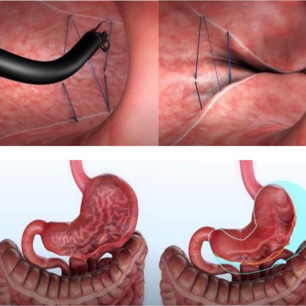 Endoscopic Sleeve Gastroplasty