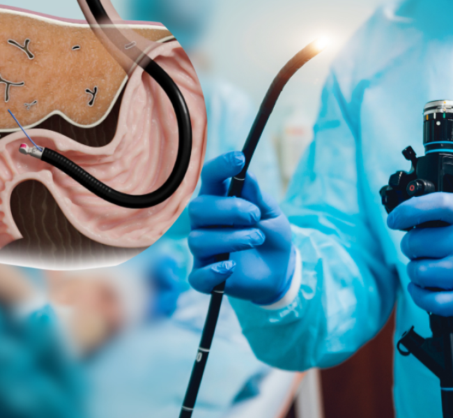 Endoscopic Ultrasound (EUS)