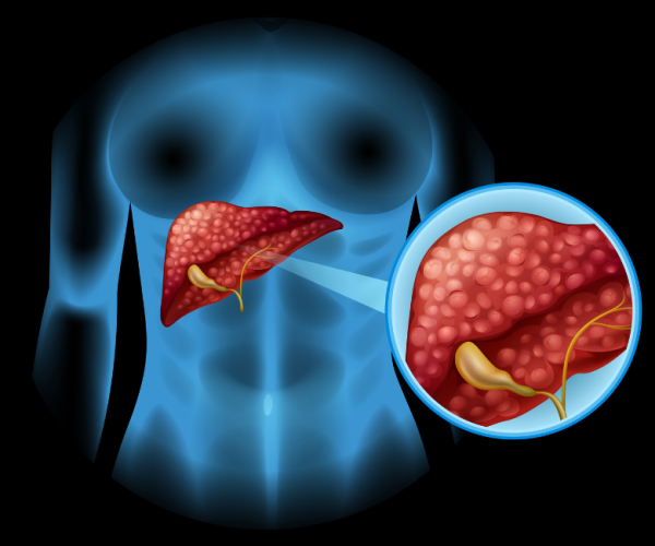 Fatty Liver