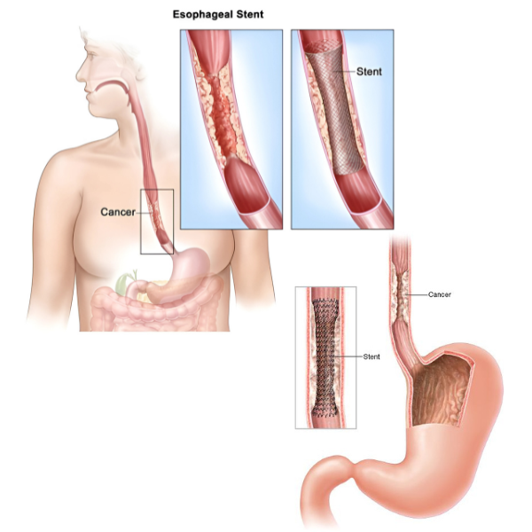 GI Stenting