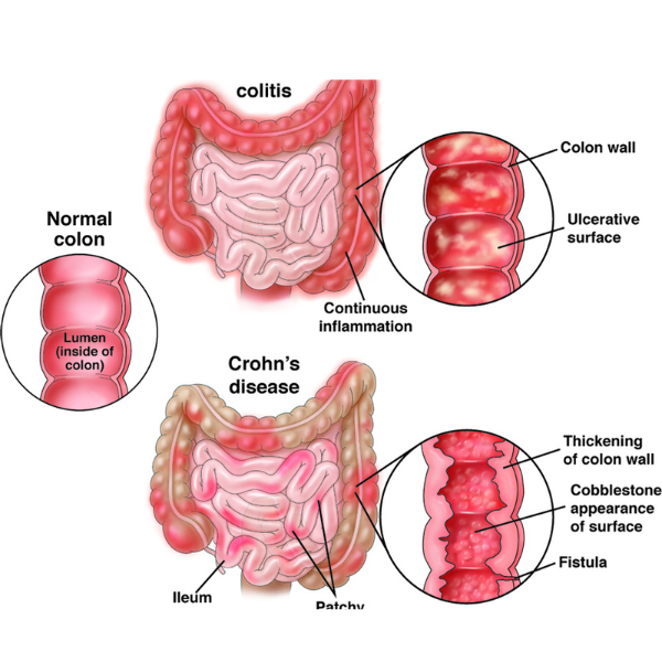Intestinal Diseases