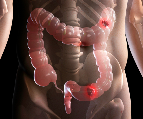 _Irritable Bowel Syndrome (IBS)