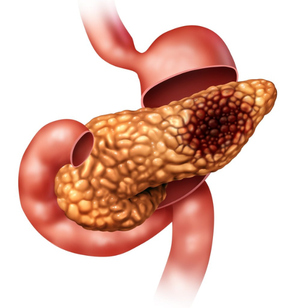 Pancreatic cancer