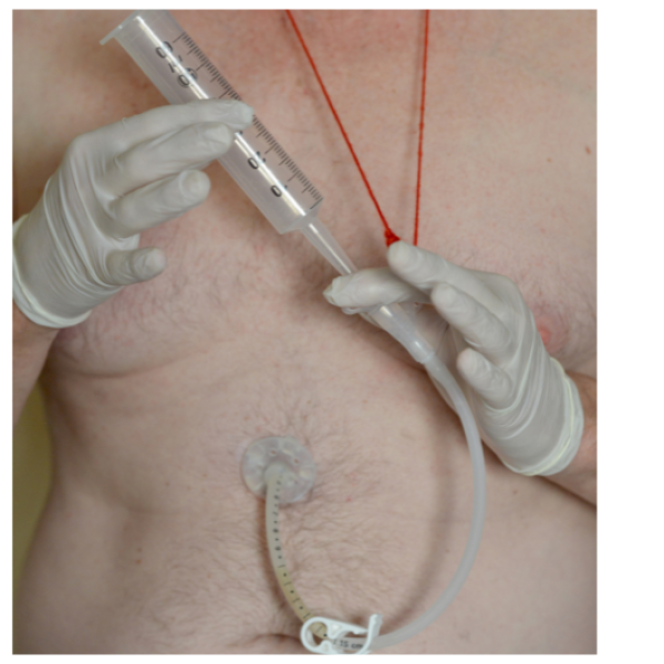 Percutaneous Endoscopic Gastrostomy (PEG) Tube Insertion